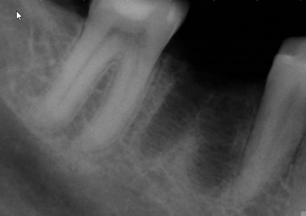 Dental X-ray showing the extraction socket remaining after a tooth has been removed