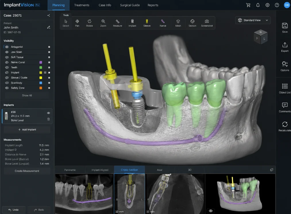 CBCT implant planning software showing guided implant placement with nerve mapping
