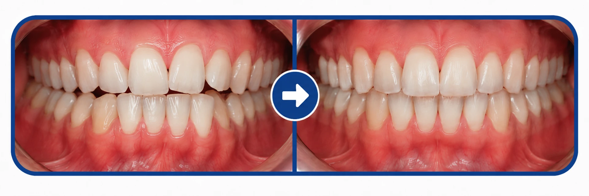 Before and after photos showing correction of midline misalignment with orthodontic treatment