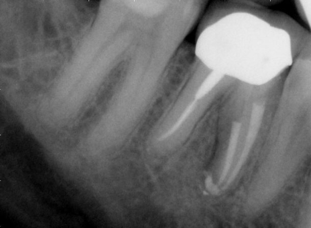 Dental X-ray showing a tooth with a fractured root that requires evaluation for removal