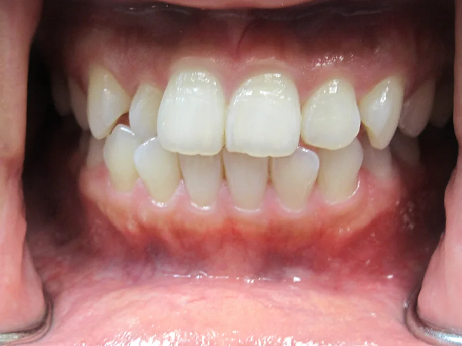 Before orthodontic treatment for anterior crossbite at Calm Dental Care