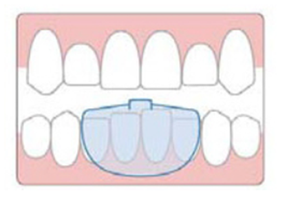 Diagram of the NTI-tss Plus appliance fitted over the lower front teeth, holding the back teeth apart