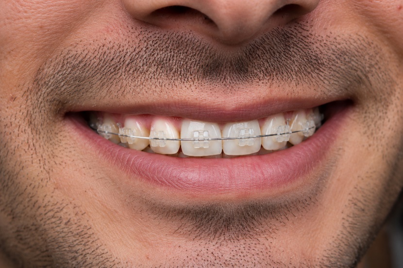 clear ceramic braces blending with natural teeth