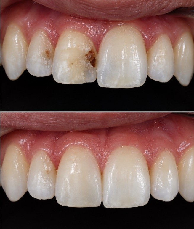 Before and after photographs of decay removal and a cosmetic composite restoration on a front tooth