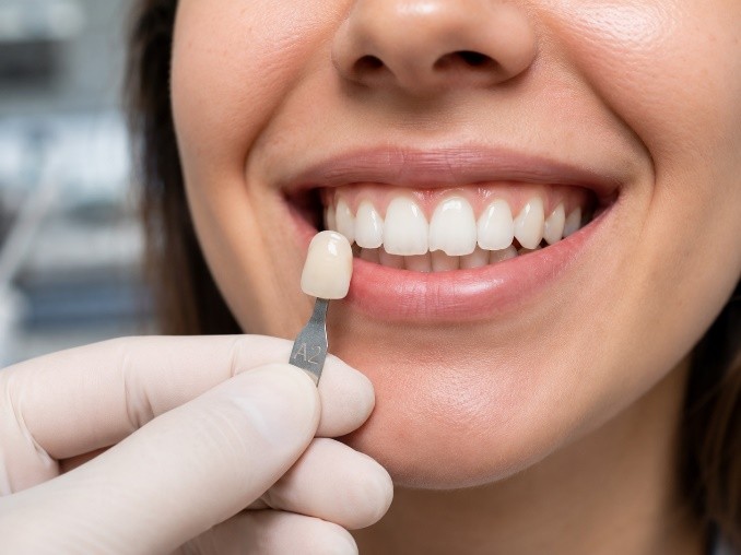 Composite shade guide held against a patient's tooth to select a matching filling shade