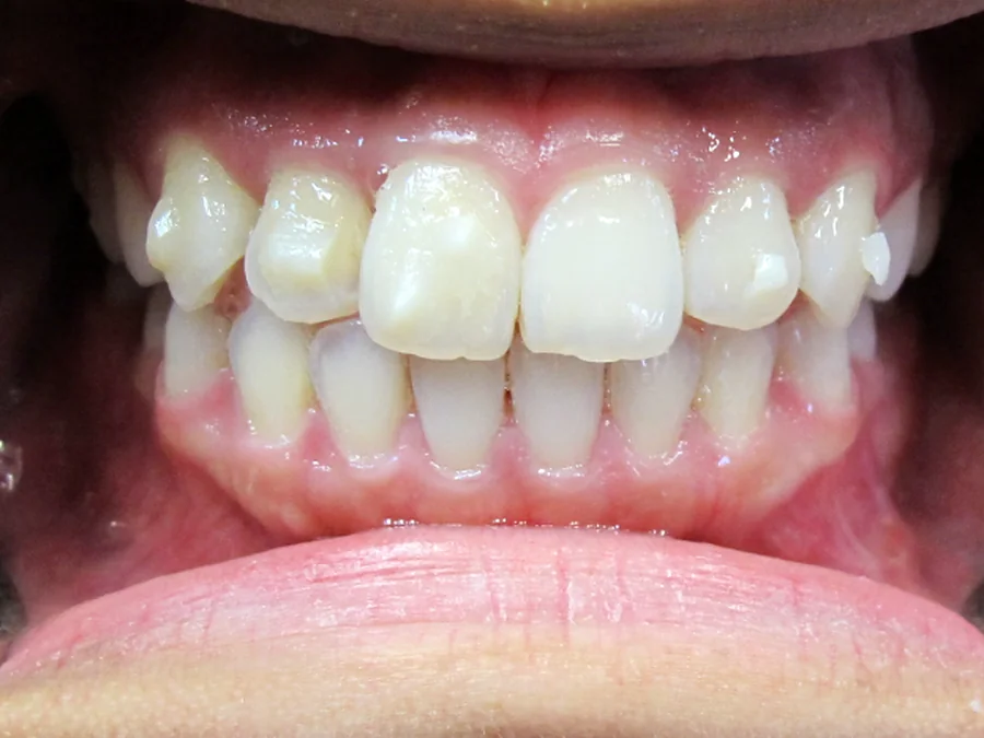 After orthodontic treatment for anterior crossbite at Calm Dental Care