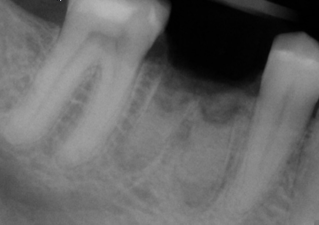 Dental X-ray showing a grafted extraction site where bone grafting is intended to help preserve ridge dimensions