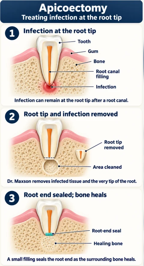 Apicoectomy in three steps: infection at the root tip, root tip and infection removed, root end sealed as bone heals