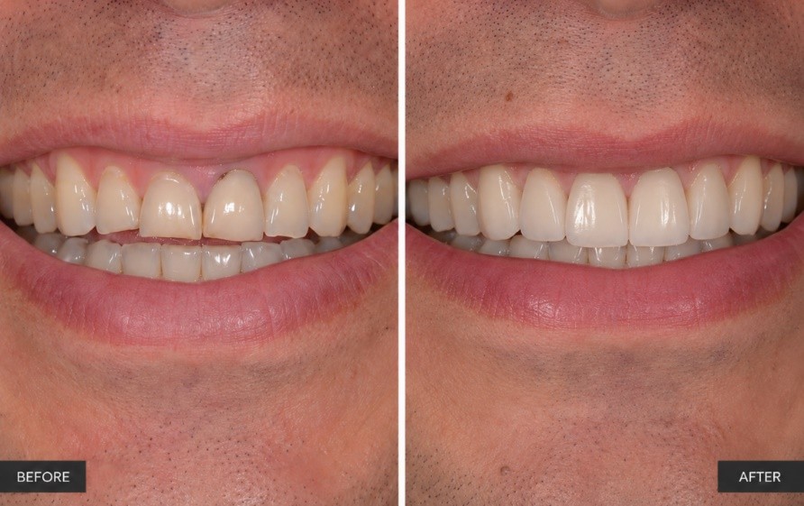 Four porcelain crowns on upper front teeth matched to the natural tooth shade