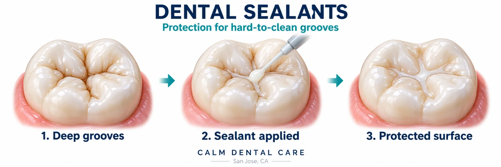 Dental sealants: a three-step illustration showing deep grooves in a molar, sealant applied into the grooves, and the protected sealed surface