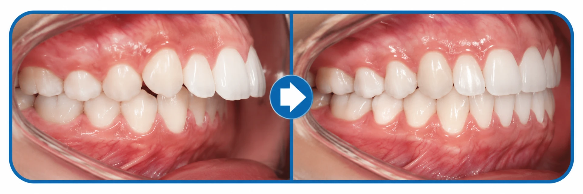 Before and after photos showing correction of excessive overjet with orthodontic treatment