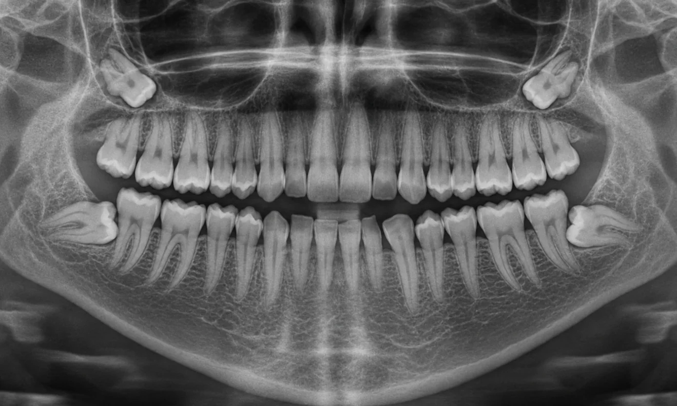 Panoramic dental X-ray showing impacted wisdom teeth at the back of the upper and lower jaws