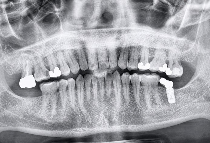 Digital panoramic x-ray